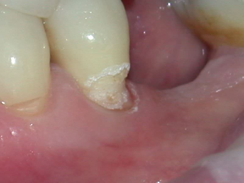 Odontología Conservadora con Láser en Clínica Dental Odontic.
