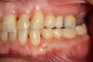 Ortodoncia transparente con Invisalign®