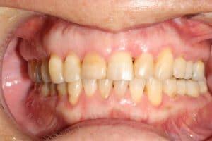 Ortodoncia transparente con Invisalign®