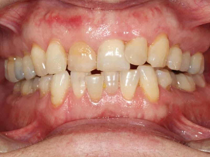 Ortodoncia transparente con Invisalign®.