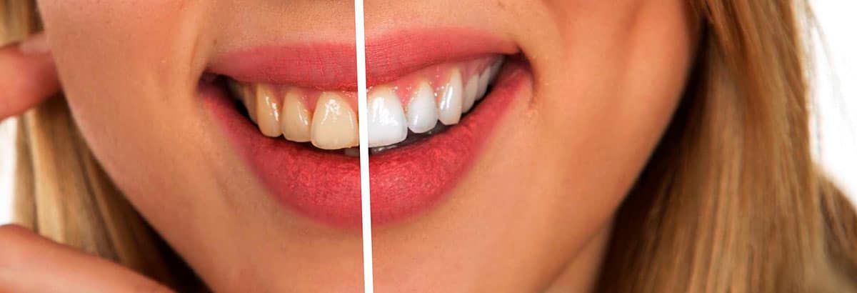 ¿Cómo se realiza un correcto blanqueamiento dental?